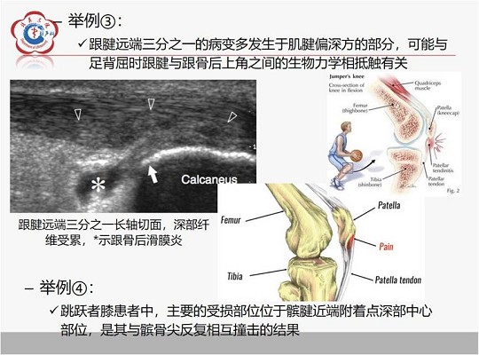 【经典超声书籍解读】肌肉骨胳超声诊断之肌腱病与部分撕裂