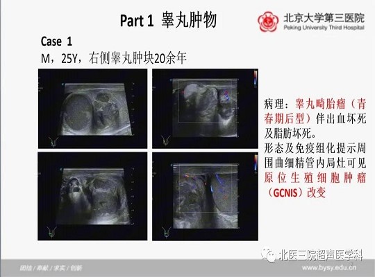 病例回顾与学习之睾丸畸胎瘤