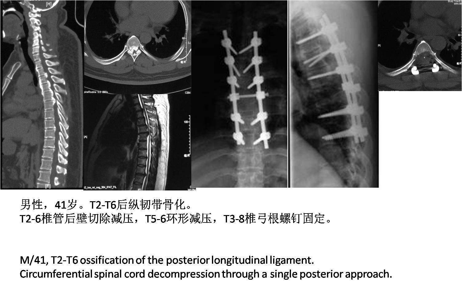 脊柱组典型病例 