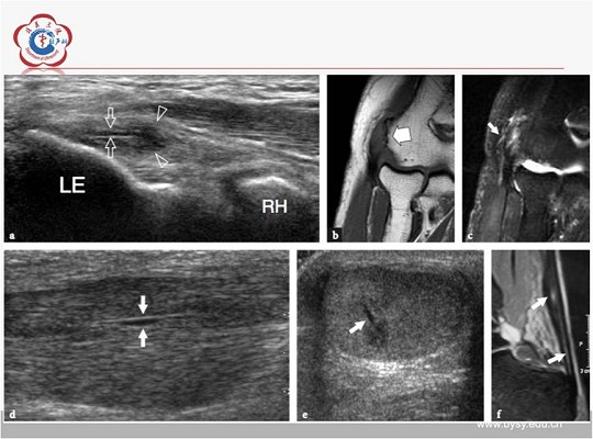【经典超声书籍解读】肌肉骨胳超声诊断之肌腱病与部分撕裂