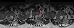 从3个病例谈脊柱原发肿瘤诊疗的特殊性