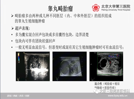 病例回顾与学习之睾丸畸胎瘤