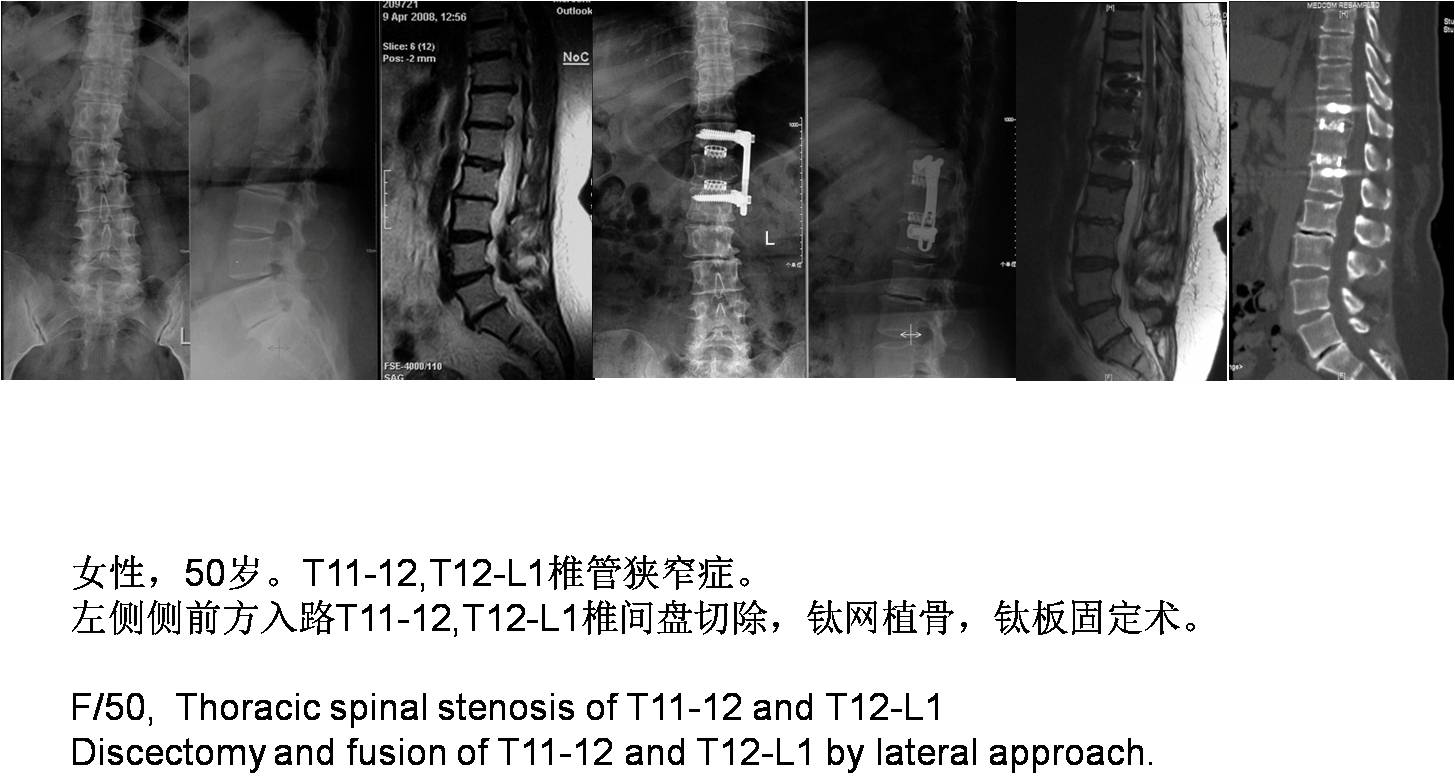 脊柱组典型病例 