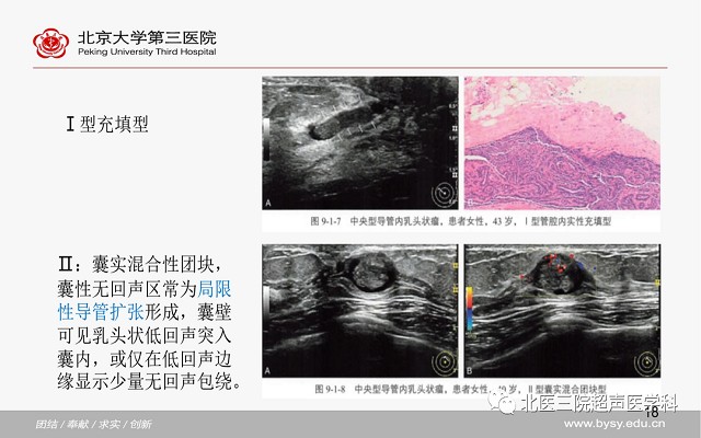 病例回顾与学习之乳腺导管内乳头状瘤