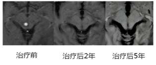 卓越的肿瘤杀手--射波刀