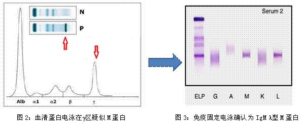 血清蛋白电泳及免疫固定电泳技术