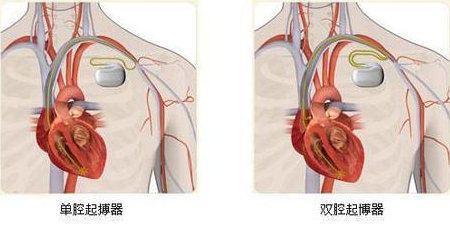 起搏器.png