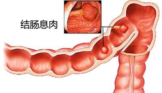 得了结肠息肉就一定会得结肠癌吗？