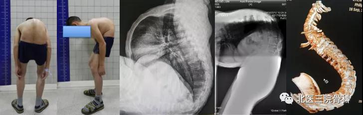 北京大学第三医院骨科脊柱畸形专业组正式成立