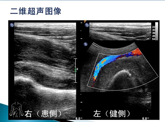 第三届中国超声造影大会病例大赛北医三院超声科获奖病例展示（三）