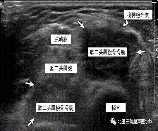 滑囊的超声评估-解剖及常见病变（二）