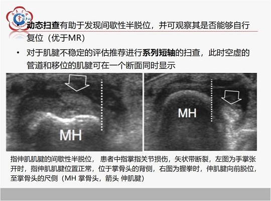 【经典超声书籍解读】肌肉骨胳超声诊断之肌腱不稳、退行性病变及肌腱撕裂