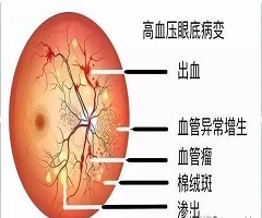 世界高血压日|无症状=无危害？“隐形杀手”没那么简单！