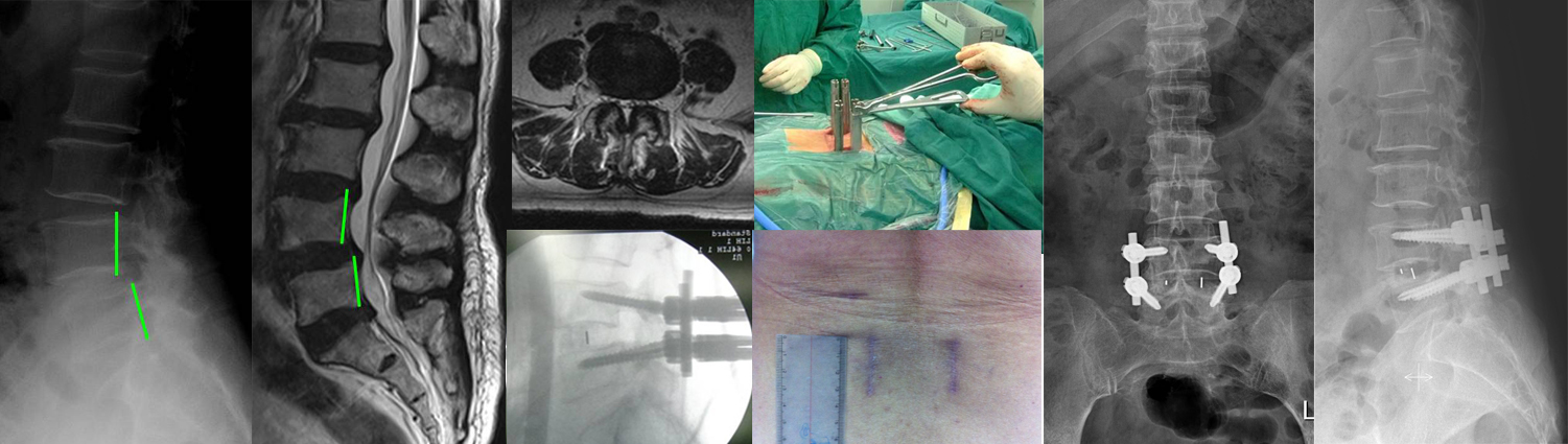 腰椎组典型病历