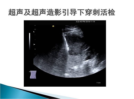第三届中国超声造影大会病例大赛北医三院超声科获奖病例展示（二）