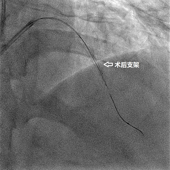 北医三院首例零造影剂血管内超声指导冠状动脉支架术成功