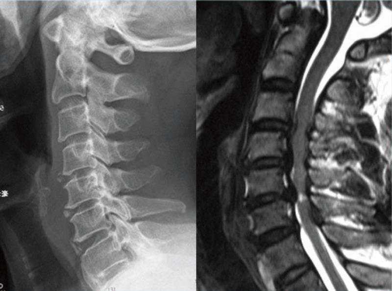 颈椎组典型病例