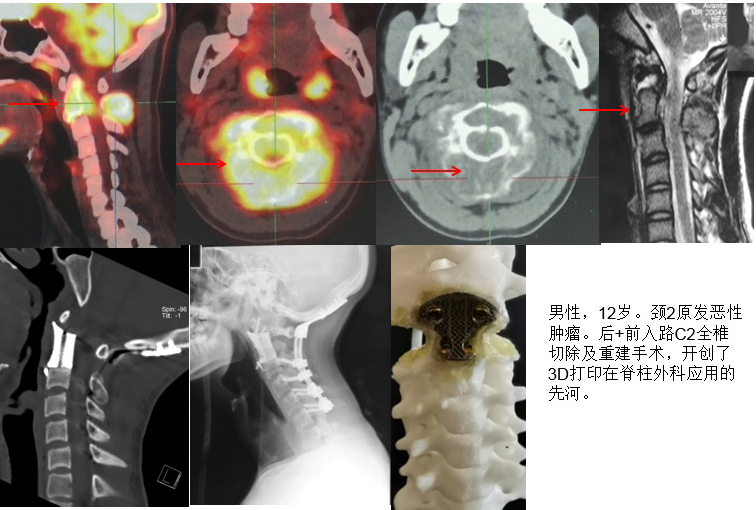 脊柱组典型病例 