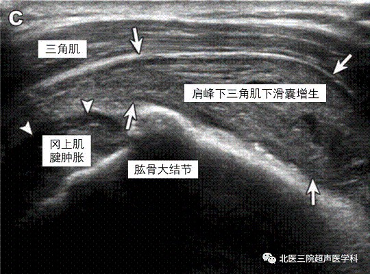 滑囊的超声评估-解剖及常见病变（一）