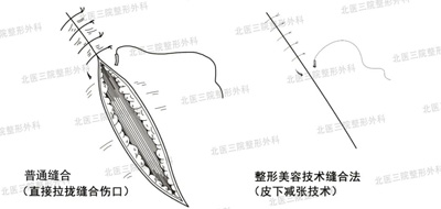 美容缝合和普通缝合的差别就是针眼大小吗?