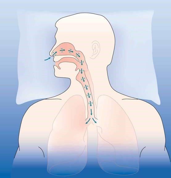 睡眠呼吸暂停综合征