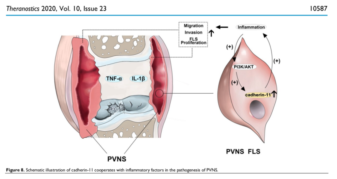 北京大学运动医学研究所敖英芳教授团队发表最新研究结果，首次揭示了Cadherin-11协同炎症因子在PVNS发病过程中的作用机制