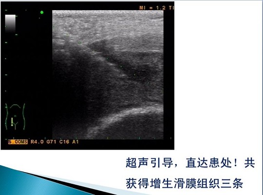 第三届中国超声造影大会病例大赛北医三院超声科获奖病例展示（四）