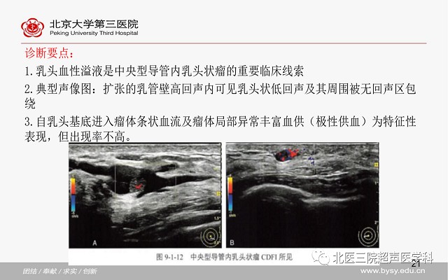 病例回顾与学习之乳腺导管内乳头状瘤