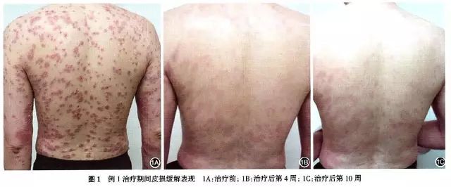 生物制剂治疗银屑病的疗效