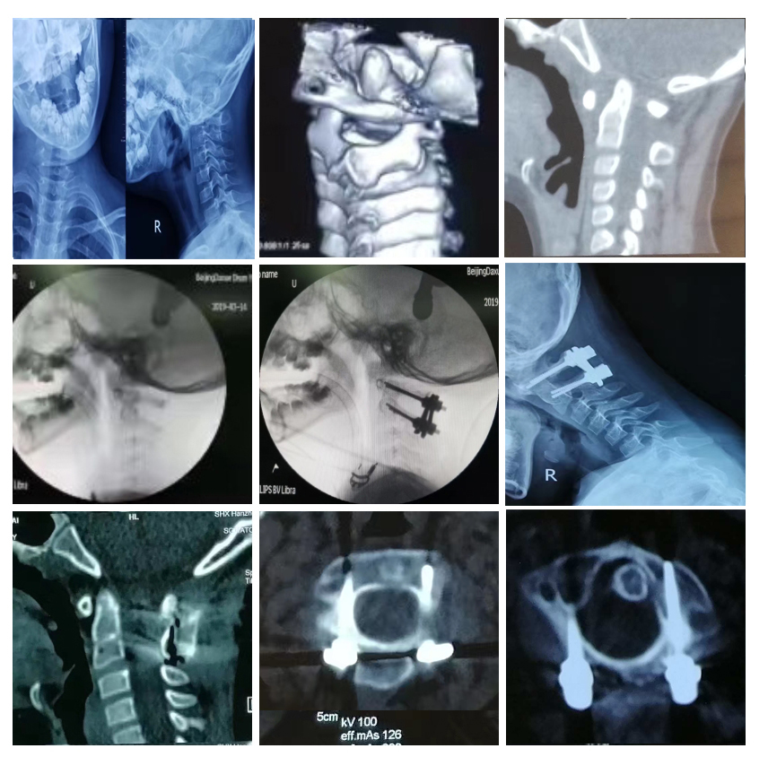 颅椎组典型病例