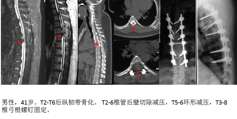 脊柱组典型病例 