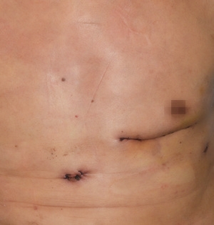 心脏中心完成国内首例小切口冠状动脉双侧乳内动脉搭桥手术