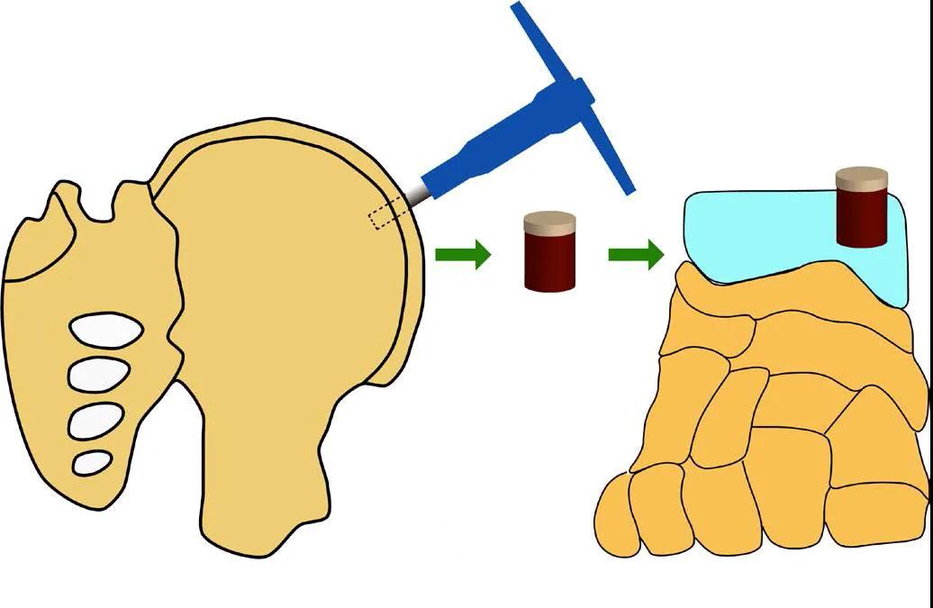 距骨骨囊肿患者重返运动场的希望：自体骨—骨膜移植【2020医疗技术创新二等奖】