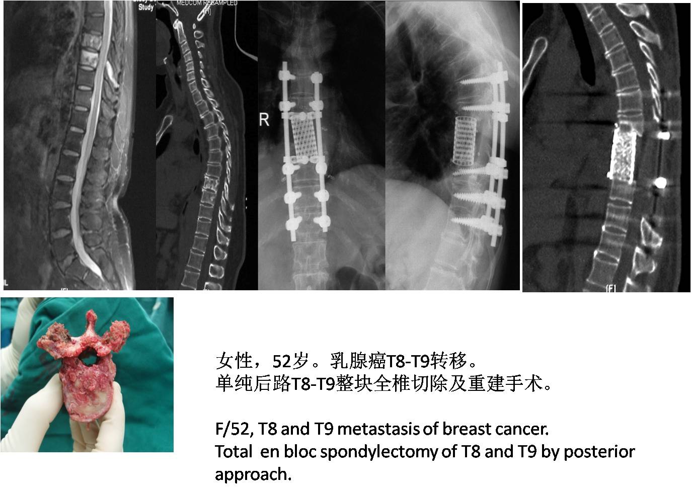 脊柱组典型病例 