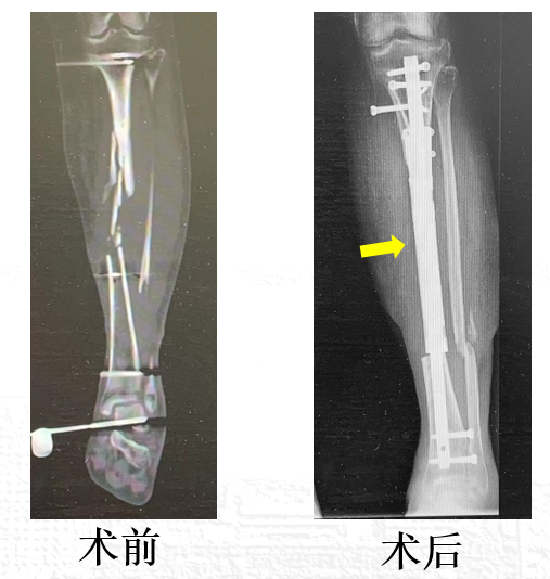 “腿在我在，腿不在我也不想活了......”——北医三院最暖MDT系列故事之一