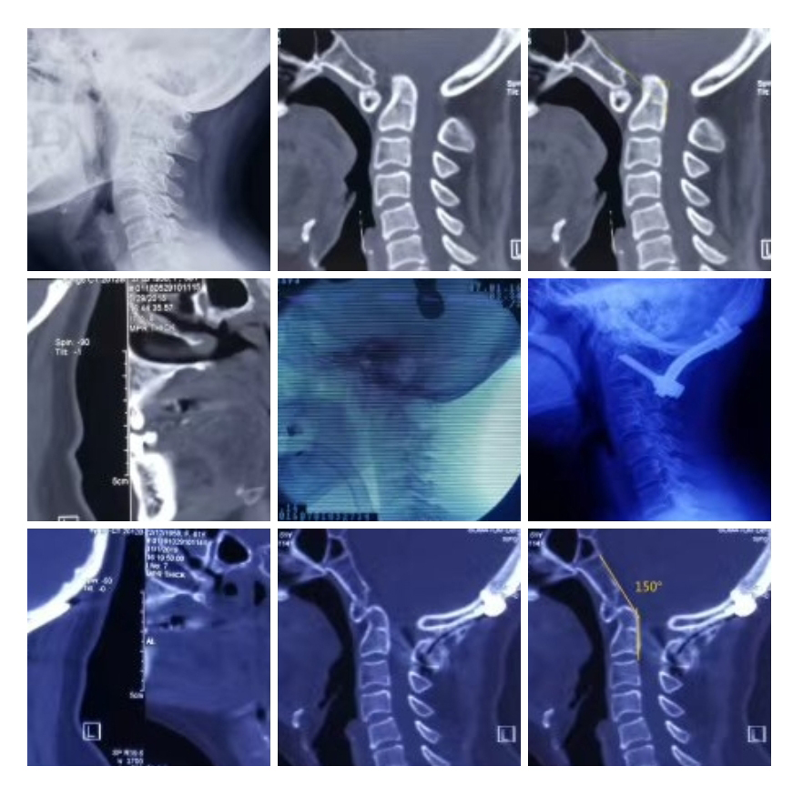 颅椎组典型病例