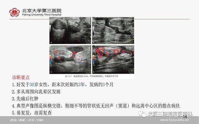 病例回顾之乳腺肉芽肿性小叶炎