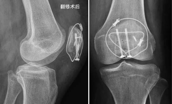 异形垫片，纵横连接——髌骨下极粉碎骨折的新选择