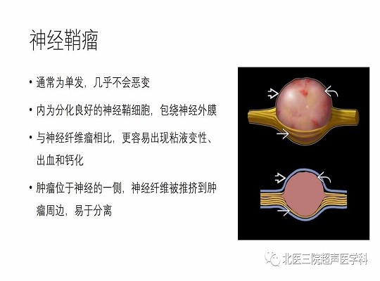 【经典超声书籍解读】周围神经肿瘤性病变(上)