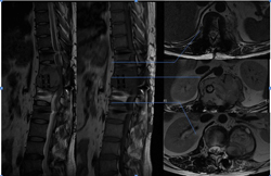 从3个病例谈脊柱原发肿瘤诊疗的特殊性