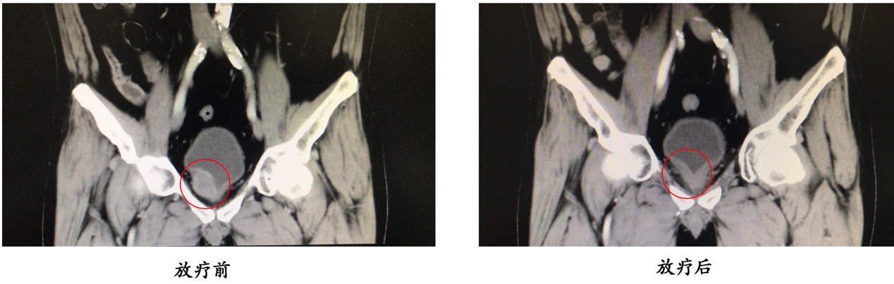 膀胱癌患者保留膀胱综合治疗
