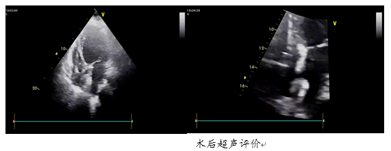 北京大学第三医院心血管内科成功完成首例心房分流器植入术