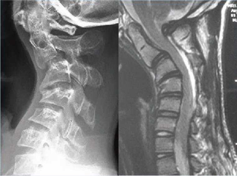 颈椎组典型病例