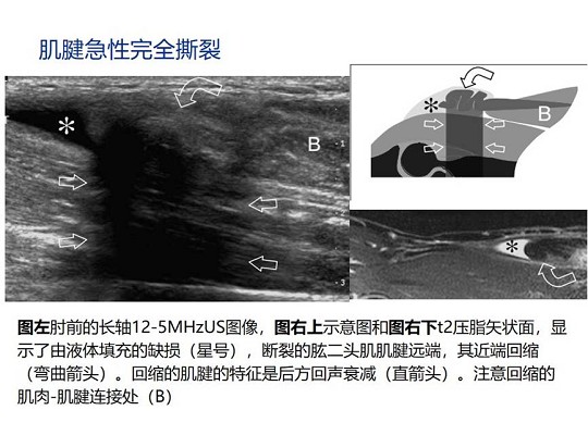 【经典超声书籍解读】肌肉骨胳超声诊断之肌腱完全撕裂和术后改变