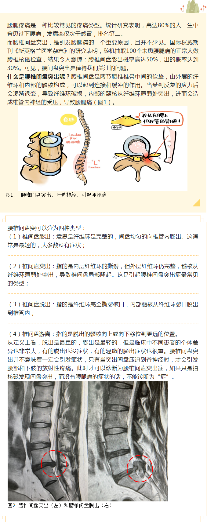 腰痛腿痛，小心腰椎间盘突出！