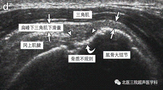 滑囊的超声评估-解剖及常见病变（一）