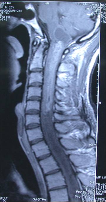 高颈段髓内肿瘤