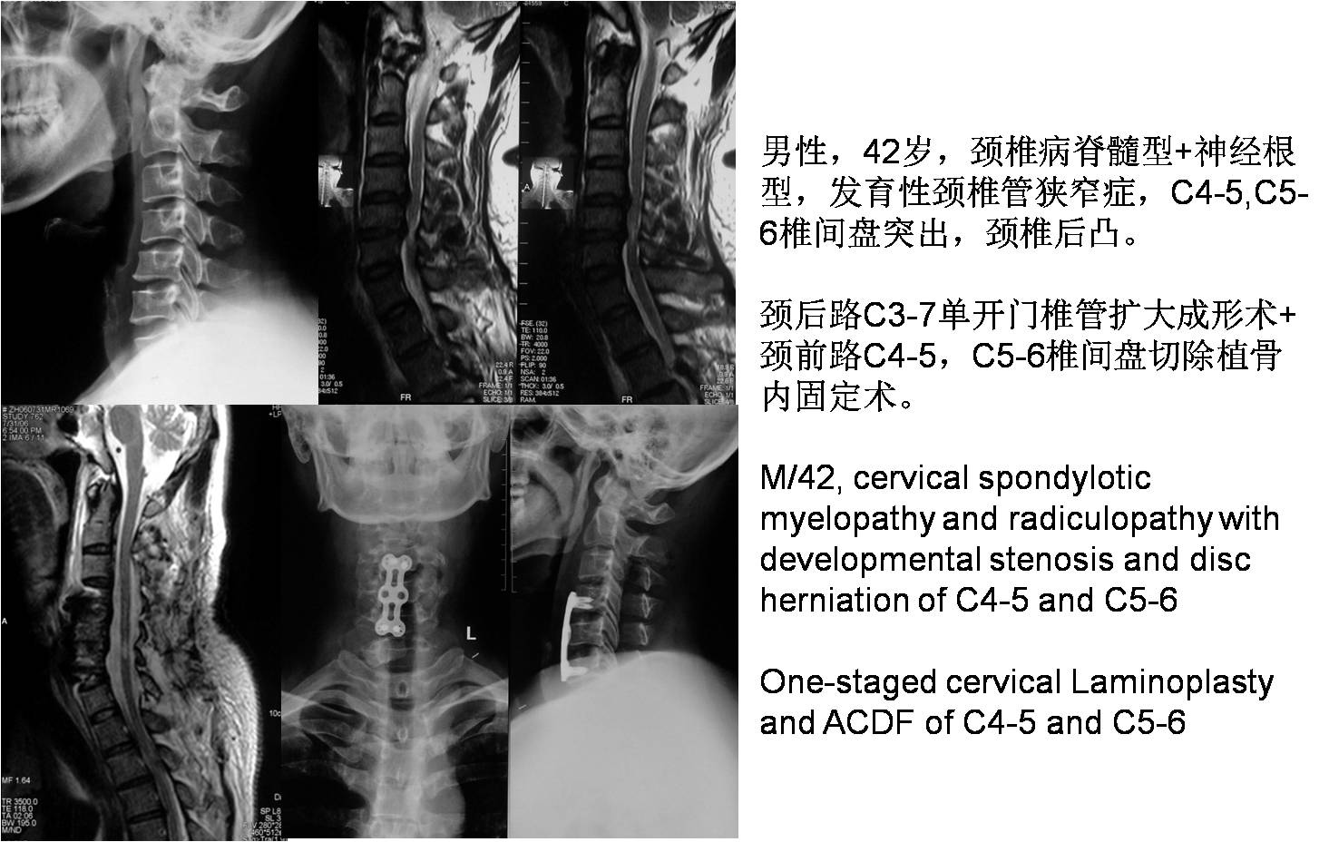 脊柱组典型病例 