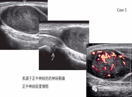 【经典超声书籍解读】周围神经肿瘤性病变(上)