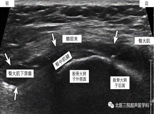 滑囊的超声评估-解剖及常见病变（二）